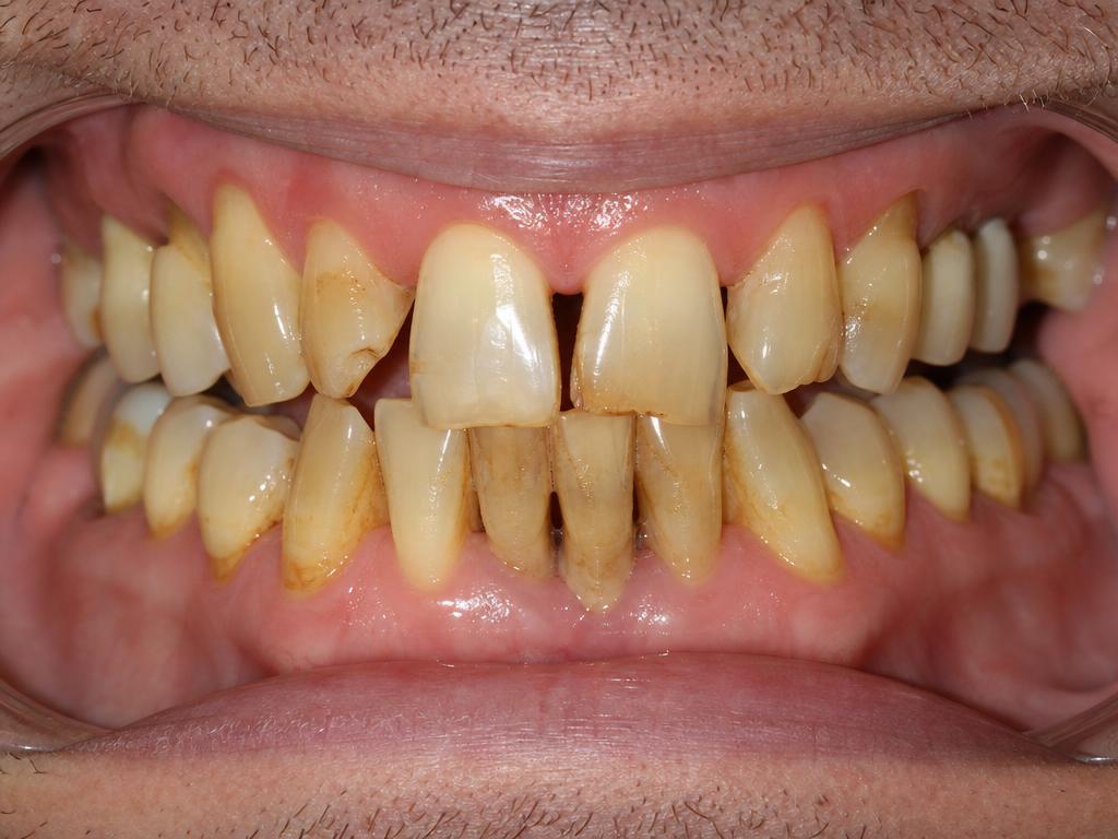 Before treatment — stained worn teeth
